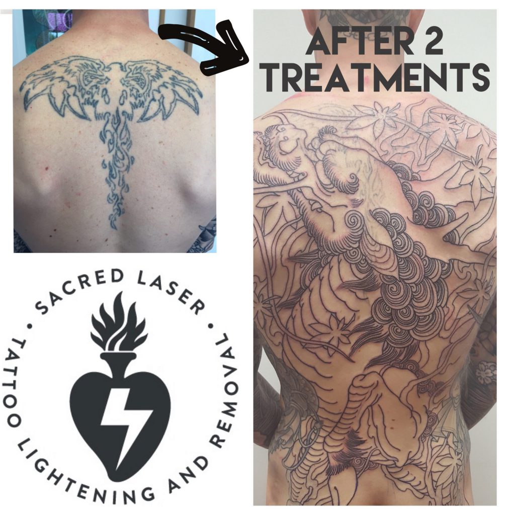 old Tattoo by clearing the way with Tattoo Removal/Lightening