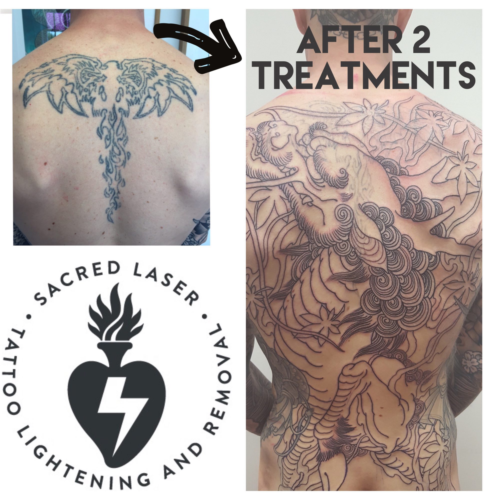 My Experience Lightening and Removing My Tattoo at Home  TatRing