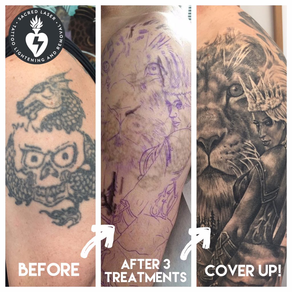 Laser Tattoo Removal