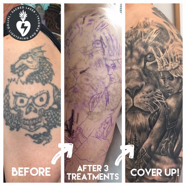 Saline Tattoo Removal (Li-FT), by Specialist Alex Milligan