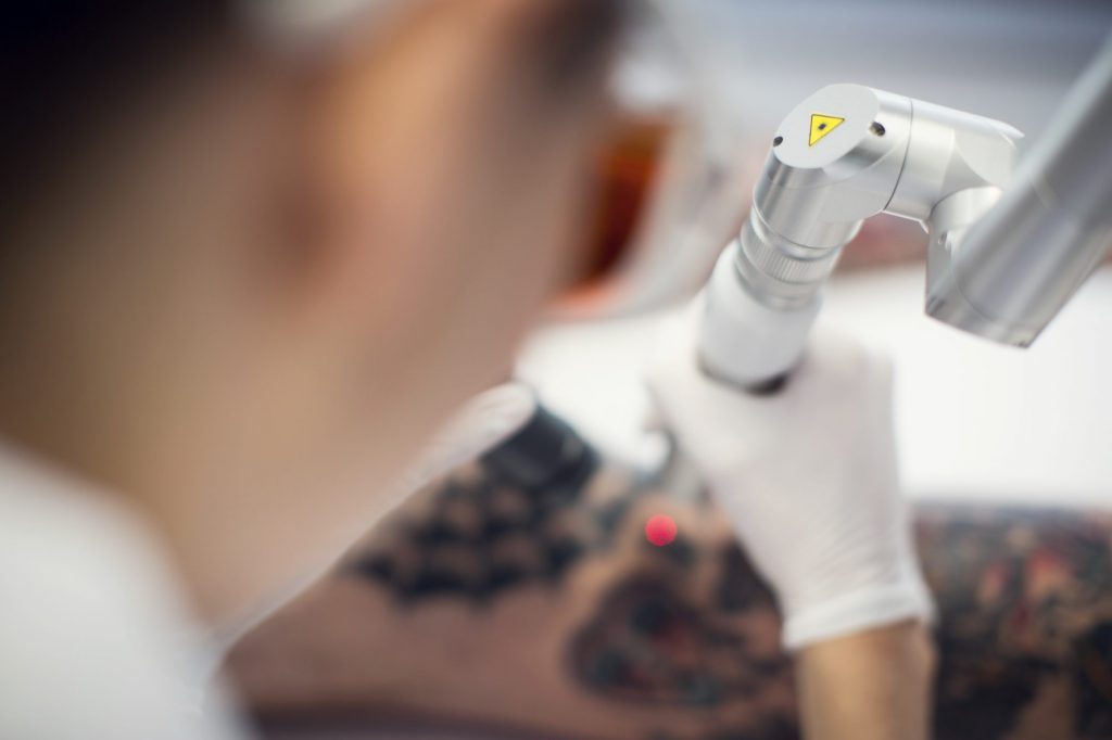 Laser Tattoo Removal Equipment Upgrade in Auckland is Better for Customers.  - Sacred Laser