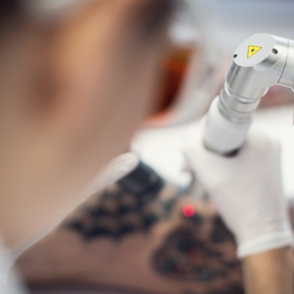 Laser Tattoo Removal Equipment Upgrade in Auckland is Better for Customers.