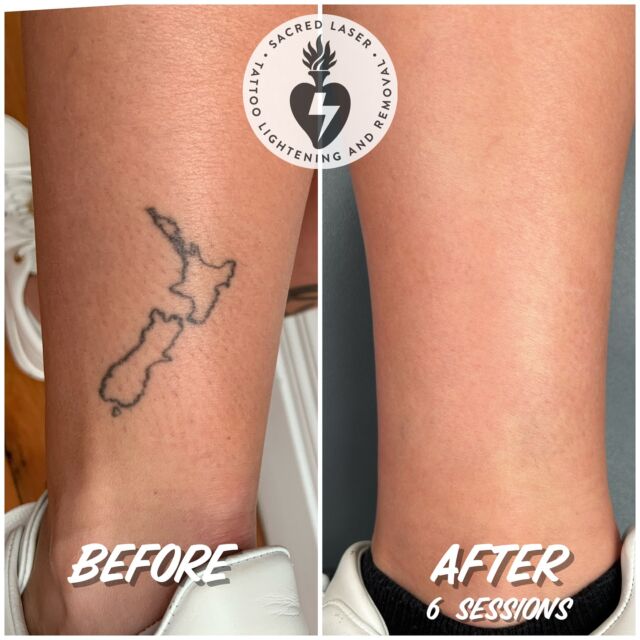 Tattoo Removal - Disappearing Ink